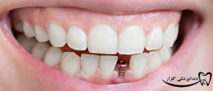 اهمیت ایمپلنت دندان جلو