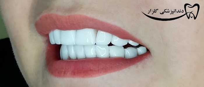 لمینیت دندان