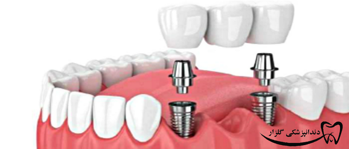 مضرات ایمپلنت دندان 