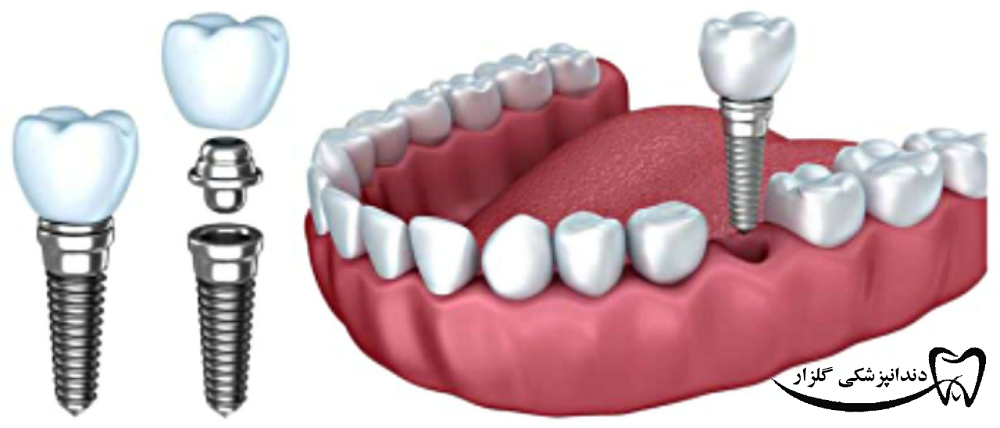 عوامل موثر در قیمت ایمپلنت دندان