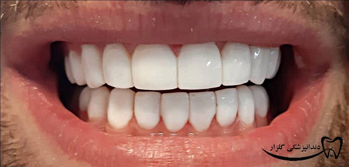 لمینت زیبای دندان 