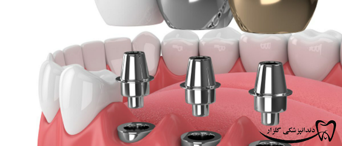 ساخت پروتز بر ایمپلنت دندان جلو