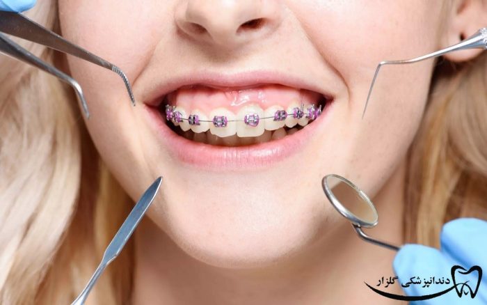 مراقبت‌های قبل از ارتودنسی دندان