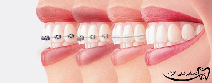 مراقبت‌های بعد از ارتودنسی دندان