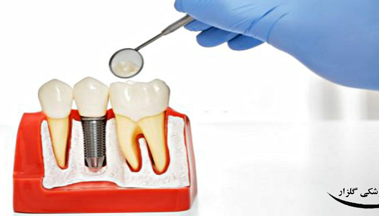 مراحل ایمپلنت دندان نیش