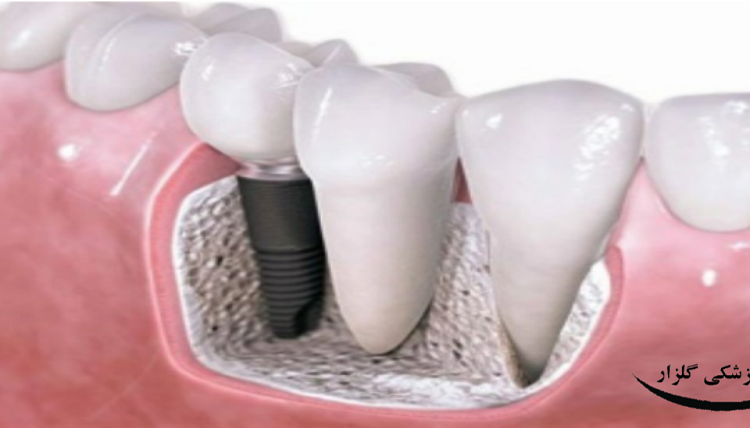 مراحل ایمپلنت دندان آسیاب